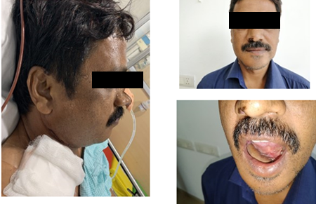 Jaw Bone Cancer Treatment in Hyderabad
